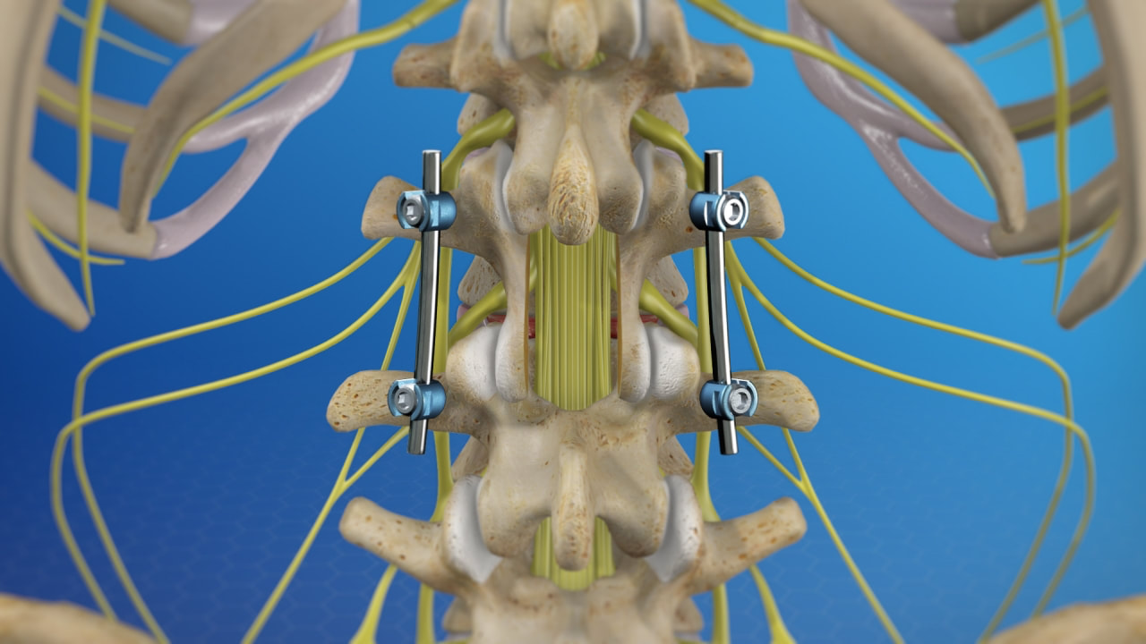 MIS-PLIF (posterior lumbar interbody fusion) procedure