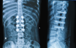 Spine Surgery and Spine Conditions