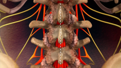 Image showing the lumbar spine with lumbar canal stenosis, prior to laminectomy. The nerves (red) are compressed by the overlying bone, or lamina. 